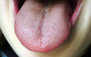 alt-systemische-candida